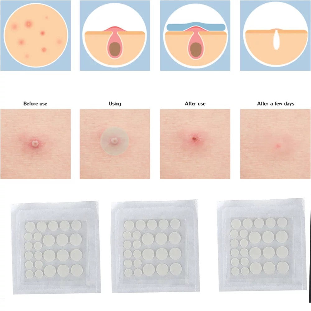 Acne Patch