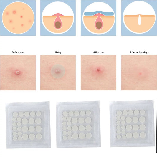 Acne Patch